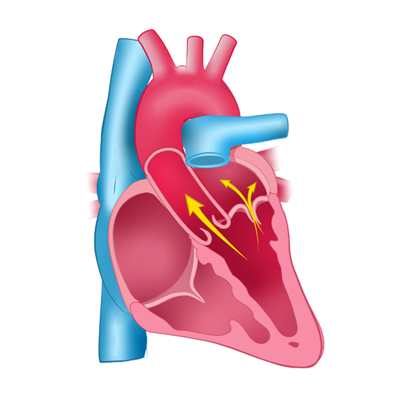 Home - Heart Valve Choice